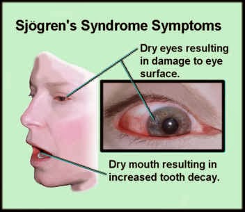 How do doctors diagnose Sjogren's syndrome?
